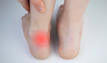 Person with Achilles Tendonitis showing inflammation near the heel, a condition that can be alleviated with custom orthotics.