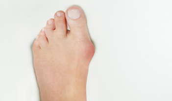 Foot with a bunion, showing the need for custom orthotics to alleviate discomfort and provide support.